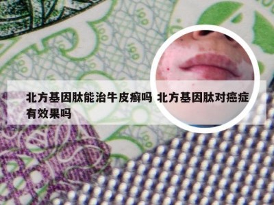 北方基因肽能治牛皮癣吗 北方基因肽对癌症有效果吗