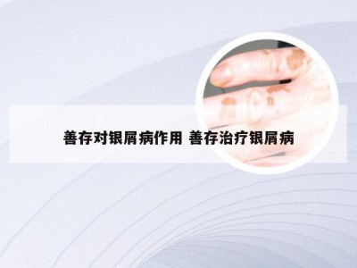 善存对银屑病作用 善存治疗银屑病