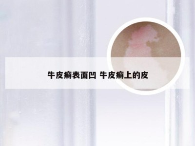 牛皮癣表面凹 牛皮癣上的皮