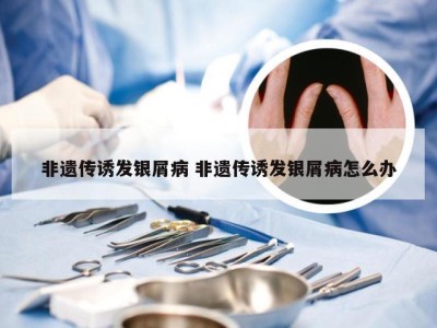 非遗传诱发银屑病 非遗传诱发银屑病怎么办