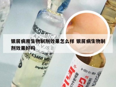 银屑病用生物制剂效果怎么样 银屑病生物制剂效果好吗
