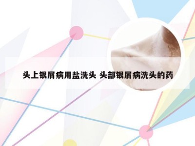 头上银屑病用盐洗头 头部银屑病洗头的药