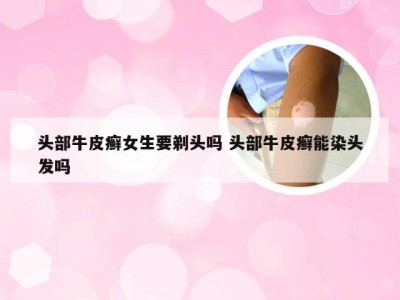 头部牛皮癣女生要剃头吗 头部牛皮癣能染头发吗