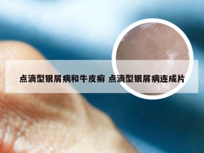 点滴型银屑病和牛皮癣 点滴型银屑病连成片