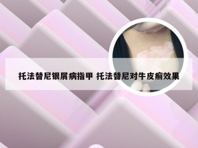 托法替尼银屑病指甲 托法替尼对牛皮癣效果