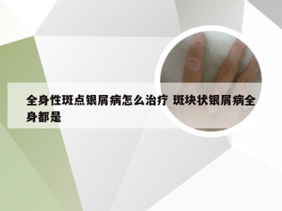 全身性斑点银屑病怎么治疗 斑块状银屑病全身都是