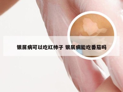 银屑病可以吃红柿子 银屑病能吃番茄吗