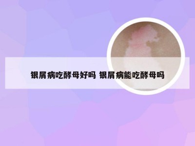 银屑病吃酵母好吗 银屑病能吃酵母吗