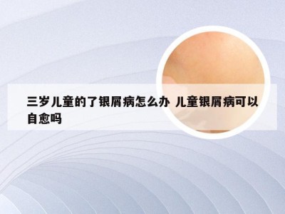 三岁儿童的了银屑病怎么办 儿童银屑病可以自愈吗