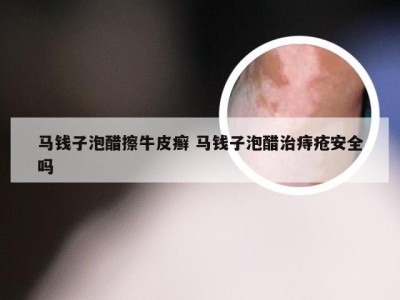 马钱子泡醋擦牛皮癣 马钱子泡醋治痔疮安全吗