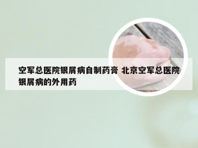 空军总医院银屑病自制药膏 北京空军总医院银屑病的外用药