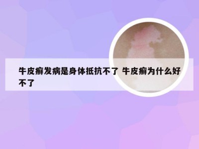 牛皮癣发病是身体抵抗不了 牛皮癣为什么好不了
