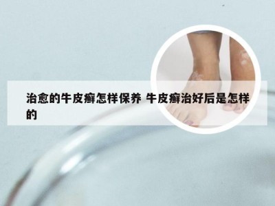 治愈的牛皮癣怎样保养 牛皮癣治好后是怎样的