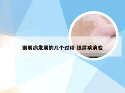 银屑病发展的几个过程 银屑病演变