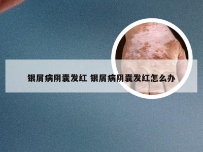 银屑病阴囊发红 银屑病阴囊发红怎么办