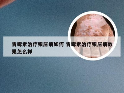 青霉素治疗银屑病如何 青霉素治疗银屑病效果怎么样