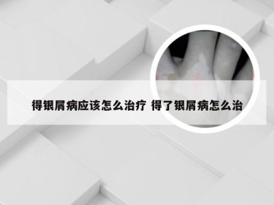 得银屑病应该怎么治疗 得了银屑病怎么治