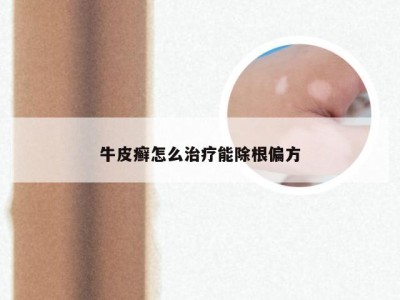 牛皮癣怎么治疗能除根偏方