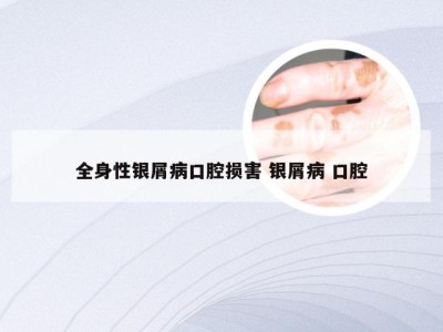 全身性银屑病口腔损害 银屑病 口腔