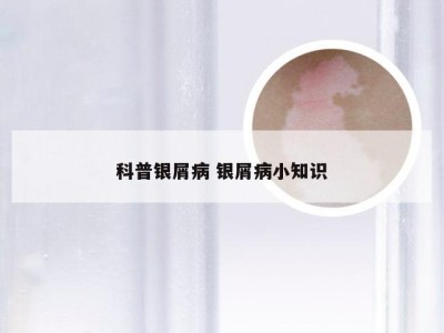 科普银屑病 银屑病小知识