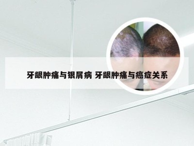 牙龈肿痛与银屑病 牙龈肿痛与癌症关系
