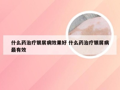 什么药治疗银屑病效果好 什么药治疗银屑病最有效