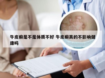 牛皮癣是不是体质不好 牛皮癣真的不影响健康吗