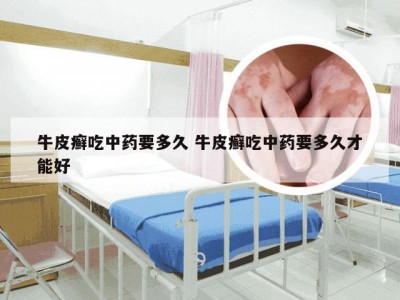 牛皮癣吃中药要多久 牛皮癣吃中药要多久才能好