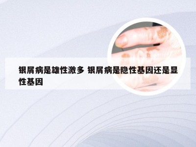 银屑病是雄性激多 银屑病是隐性基因还是显性基因