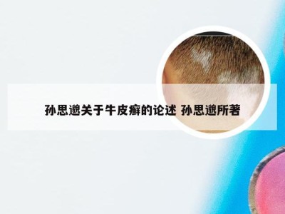 孙思邈关于牛皮癣的论述 孙思邈所著