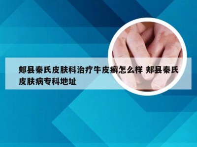 郏县秦氏皮肤科治疗牛皮癣怎么样 郏县秦氏皮肤病专科地址
