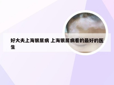 好大夫上海银屑病 上海银屑病看的最好的医生