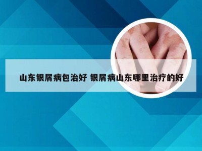 山东银屑病包治好 银屑病山东哪里治疗的好
