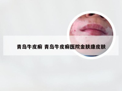 青岛牛皮癣 青岛牛皮癣医院金肤康皮肤