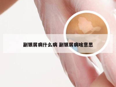 副银屑病什么病 副银屑病啥意思