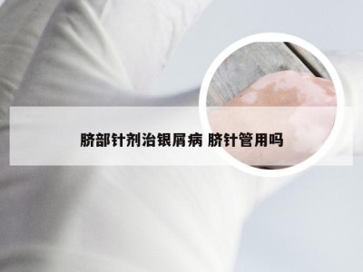 脐部针剂治银屑病 脐针管用吗