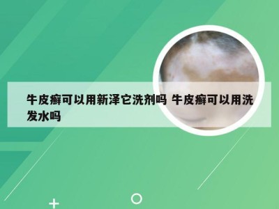 牛皮癣可以用新泽它洗剂吗 牛皮癣可以用洗发水吗