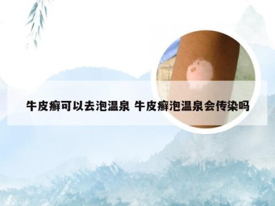 牛皮癣可以去泡温泉 牛皮癣泡温泉会传染吗