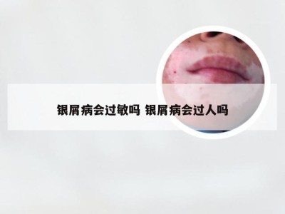 银屑病会过敏吗 银屑病会过人吗