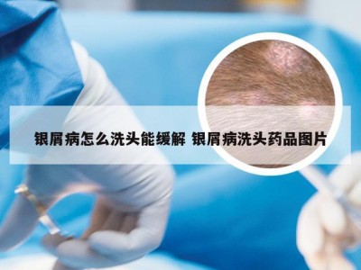 银屑病怎么洗头能缓解 银屑病洗头药品图片