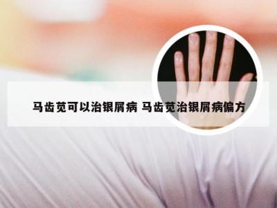 马齿苋可以治银屑病 马齿苋治银屑病偏方