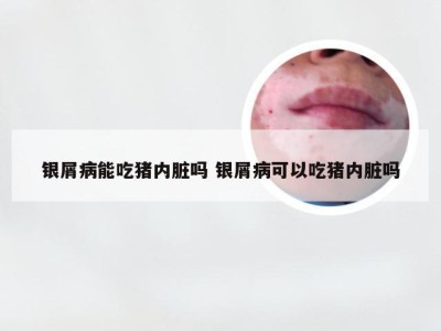 银屑病能吃猪内脏吗 银屑病可以吃猪内脏吗