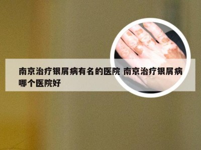 南京治疗银屑病有名的医院 南京治疗银屑病哪个医院好