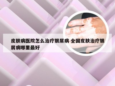 皮肤病医院怎么治疗银屑病 全国皮肤治疗银屑病哪里最好