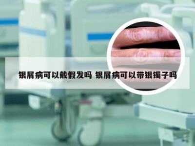 银屑病可以戴假发吗 银屑病可以带银镯子吗