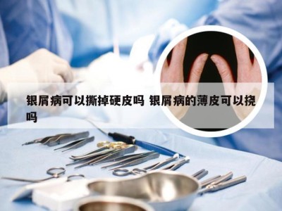 银屑病可以撕掉硬皮吗 银屑病的薄皮可以挠吗