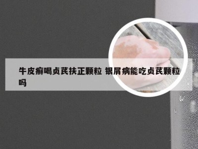 牛皮癣喝贞芪扶正颗粒 银屑病能吃贞芪颗粒吗