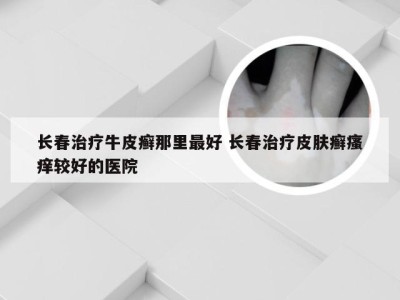 长春治疗牛皮癣那里最好 长春治疗皮肤癣瘙痒较好的医院
