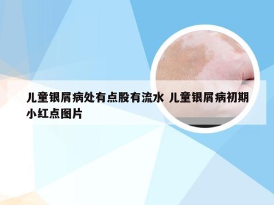 儿童银屑病处有点股有流水 儿童银屑病初期小红点图片