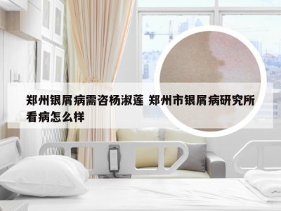 郑州银屑病需咨杨淑莲 郑州市银屑病研究所看病怎么样